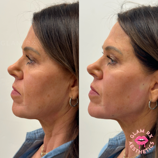 Achieve the Perfect Profile with Chin Filler: Your Secret to Profile Perfection