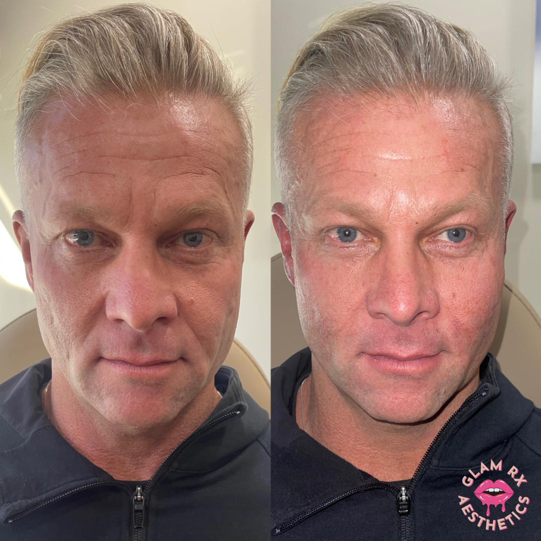 A side by side photo shows a man before and after receiving cheek filler treatments and sculptra treatmentss