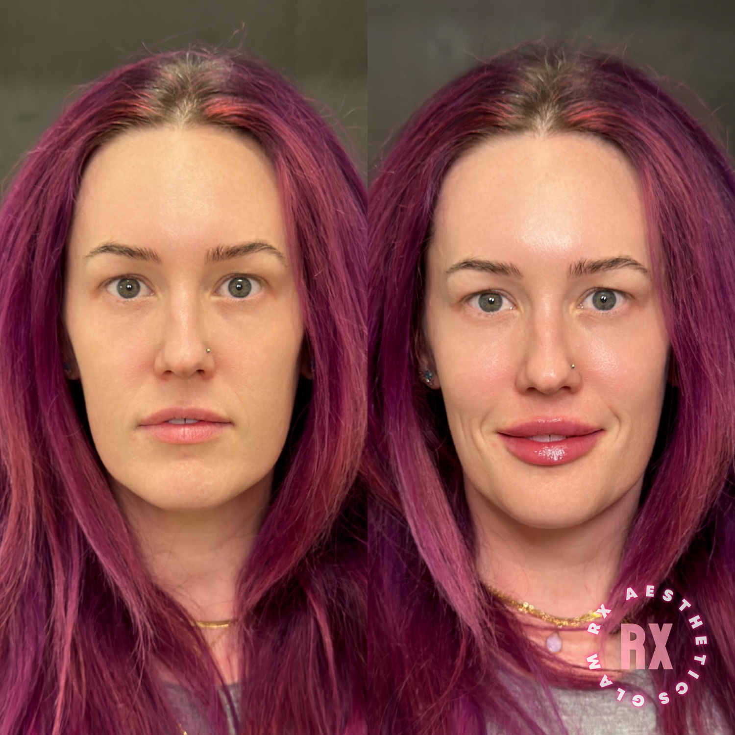 A split photo showing a woman with purple hair before and after getting lip filler injections